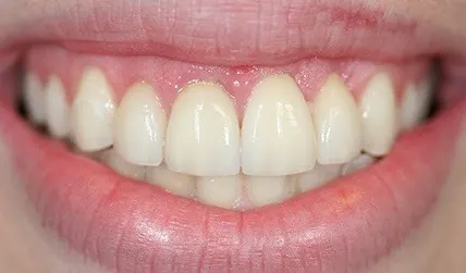 Evenly proportioned teeth