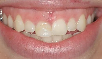 Oversized front teeth