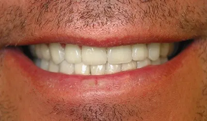Evenly spaced teeth