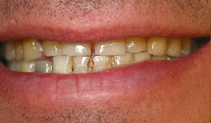 Gapped smile