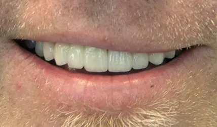 Healthy and evenly spaced smile