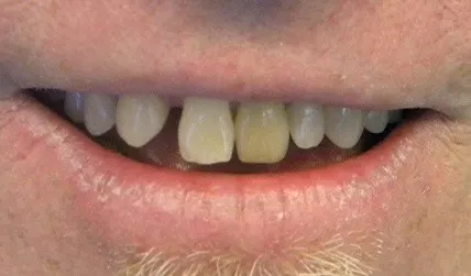 Unhealthy and gapped smile