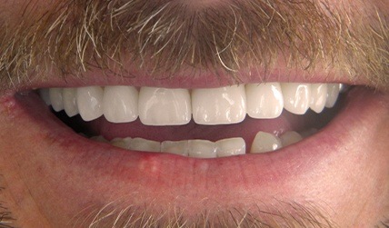 Closed gap between front teeth