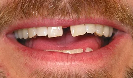 Gap between front teeth