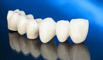 Custom fixed bridge prior to placement