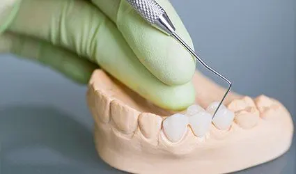Model smile with fixed bridge restoration