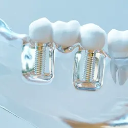 Model of implant-supported bridge
