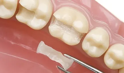 Closeup of smile with inlay restoration