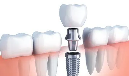 Animation of implant placement process