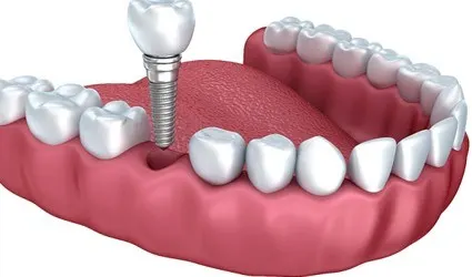 Illustration of dental implant and crown being placed in lower arch