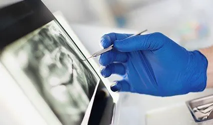 Hand pointing to dental x-rays