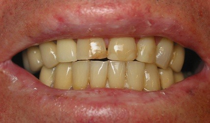 Yellowed decayed teeth