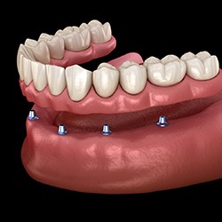Diagram of All-On-4 implant dentures in Park City