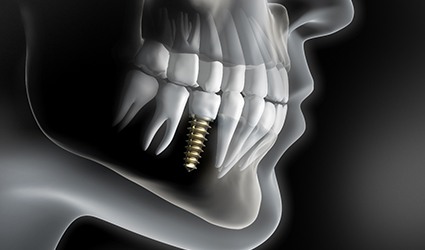 diagram of stable dental implant in Park City