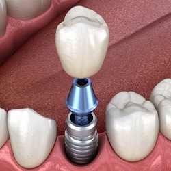 diagram of how dental implants in Park City work 