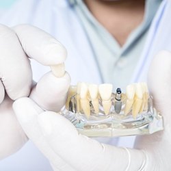 Park City implant dentist holding final restoration for dental implant