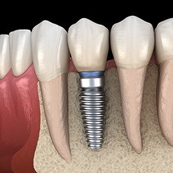 image of single tooth dental implant in Park City