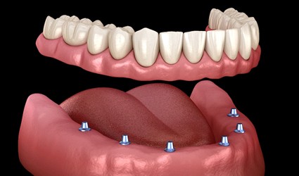 six dental implants supporting an implant denture